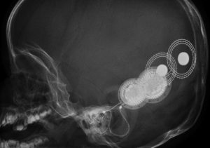 A profile x-ray of a skull with a cochlear implant.